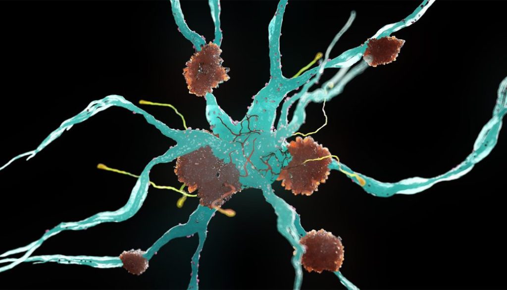 ADHD Linked to Late-Life Dementia