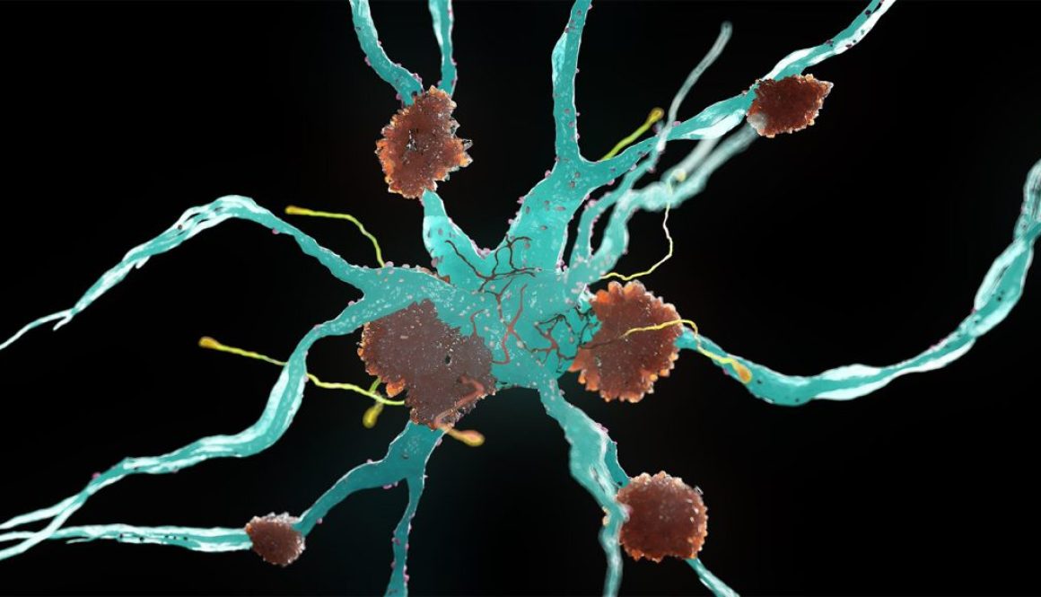 ADHD Linked to Late-Life Dementia